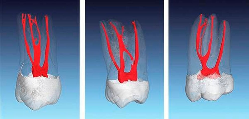 die-anatomie-von-oberkiefer-molaren-zm-online