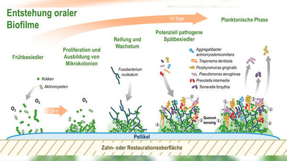 Abb. 1: Schematische Darstellung der Entstehung oraler Biofilme auf Zahn- oder Restaurationsoberflächen