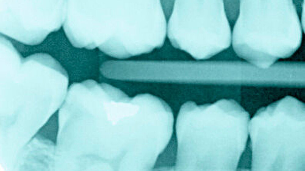 Abbildung 5: Karies ist nach wie vor ein ernst zu nehmendes Gesundheitsproblem. So findet man selbst bei Patienten mit klinisch nahezu kariesfreiem Gebiss nach der Anfertigung von Bissflügelaufnahmen nicht selten approximale Kariesläsionen (Zahn 46 distal), die tief bis ins Dentin reichen. |
