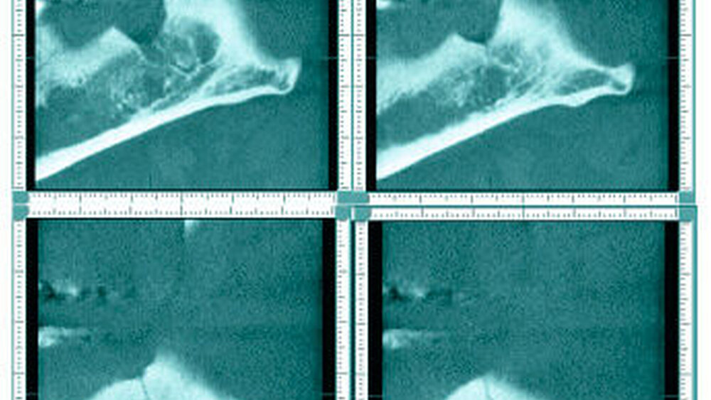 Abbildung 3: Weitere sagittale Ansichten von medial kommend (oben links) nach lateral auslaufend (unten rechts) mit Darstellung der Frakturlinie |