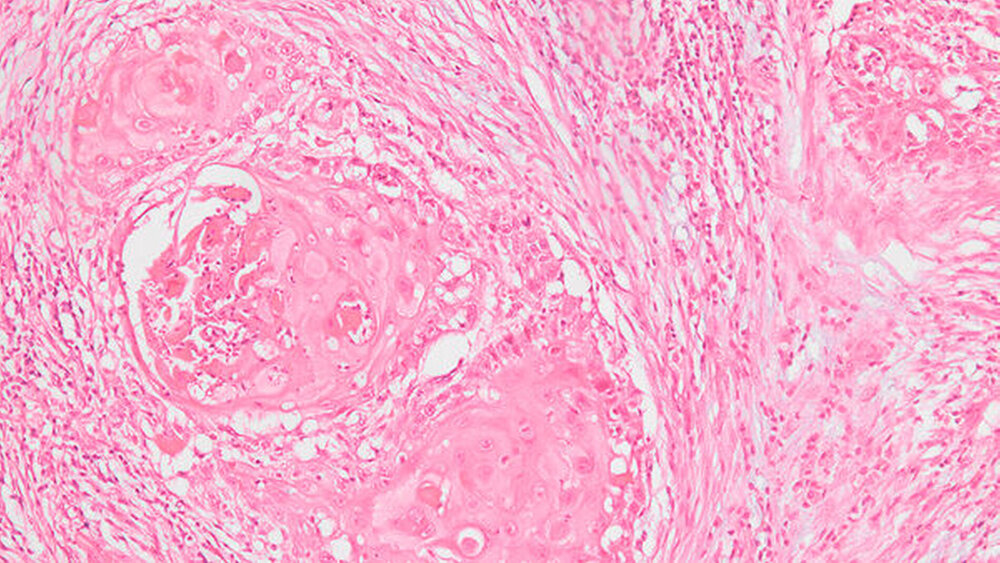 Abbildung 6: Histologisch erkennt man fibroepitheliales Gewebe mit Proliferaten zytologisch abnormen Plattenepithels bei mäßiggradigen Kerngrößenschwankungen. |