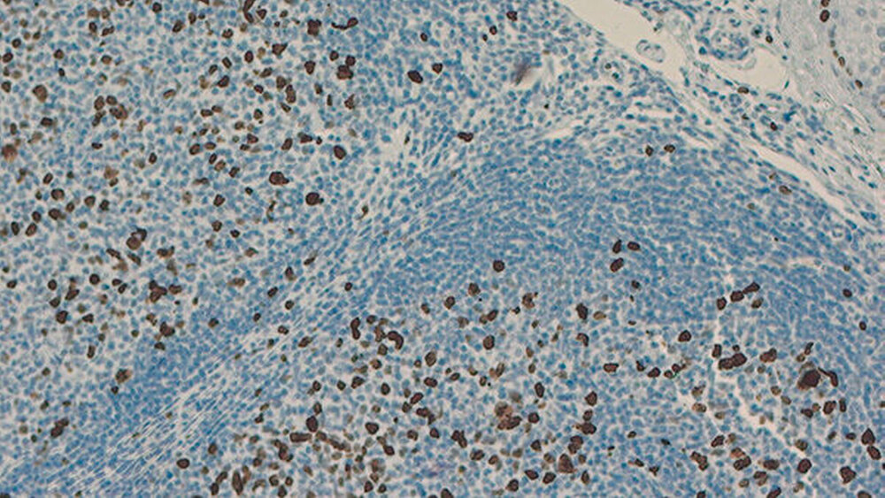 148646-flexible-1900 Abbildung 4: Immunhistologische Färbung auf Ki67-Präparat zur Bestimmung der Wachstumsfraktion des follikulären Lymphoms. Ki67-Positivität stellt sich dunkelbraun dar (Originalvergrößerung x 2,5). |