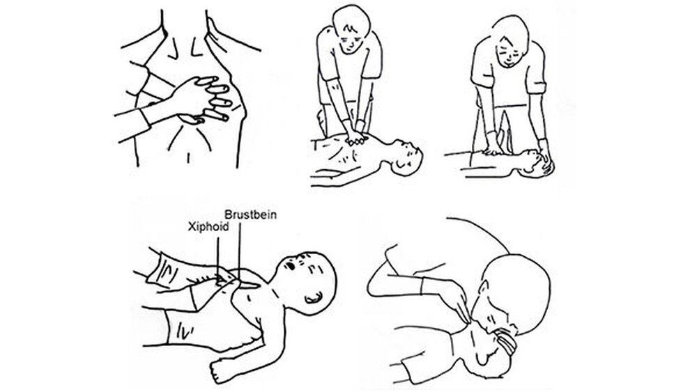 Abbildung 3: Korrekte Handpositionen bei der Thoraxkompression beim Erwachsenen, beim Kind und beim Säugling. Schematisches Vorgehen bei der Atemspende |