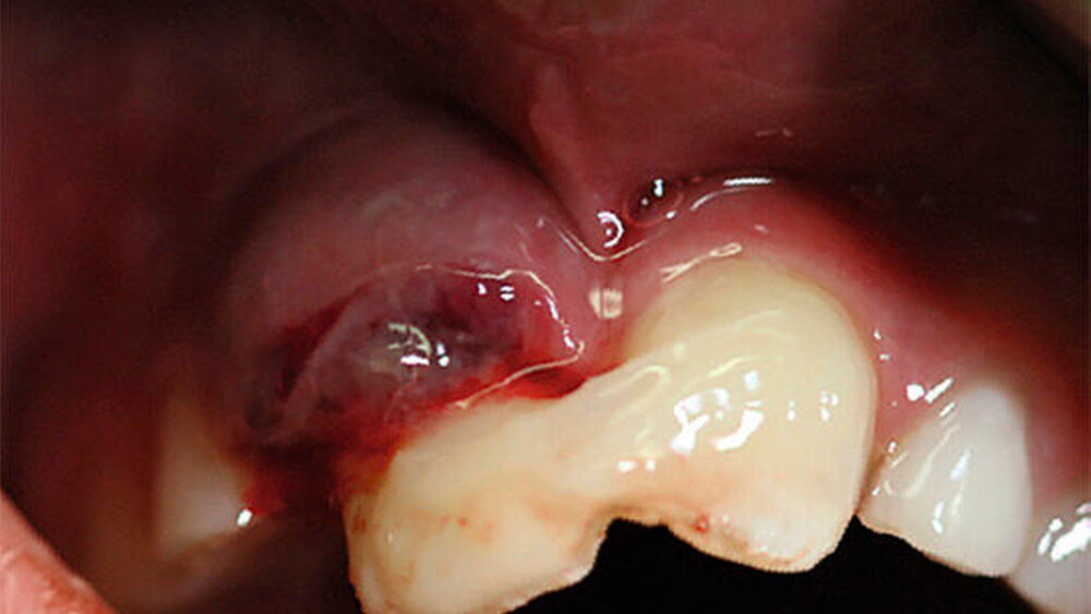 Abbildung 1: rötlich-livide, vestibulär gelegene Auftreibung der Gingiva regio 11 mit begleitender deutlicher Elongation des Zahnes 11: Bei Lockerungsgrad III war dieser bereits alio loco durch Kunststoff mit Zahn 21 verblockt worden. Aus dem Parodontalspalt entleerte sich blutig tingierter Pus. |