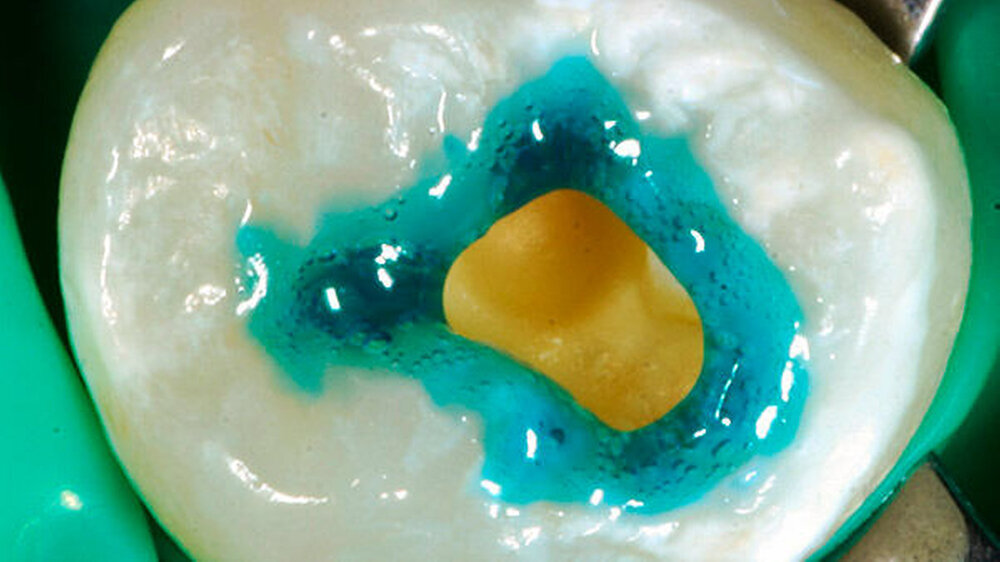 Abbildung 2: Applikation von 37-prozentiger Phosphorsäure auf die Schmelzanteile der Kavität.