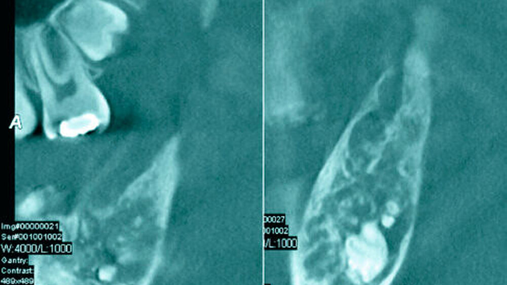 Abbildung 2: Digitale Volumentomografie: Im DVT imponieren zahlreiche, in der Mandibula gelegene, zahnähnliche Strukturen |