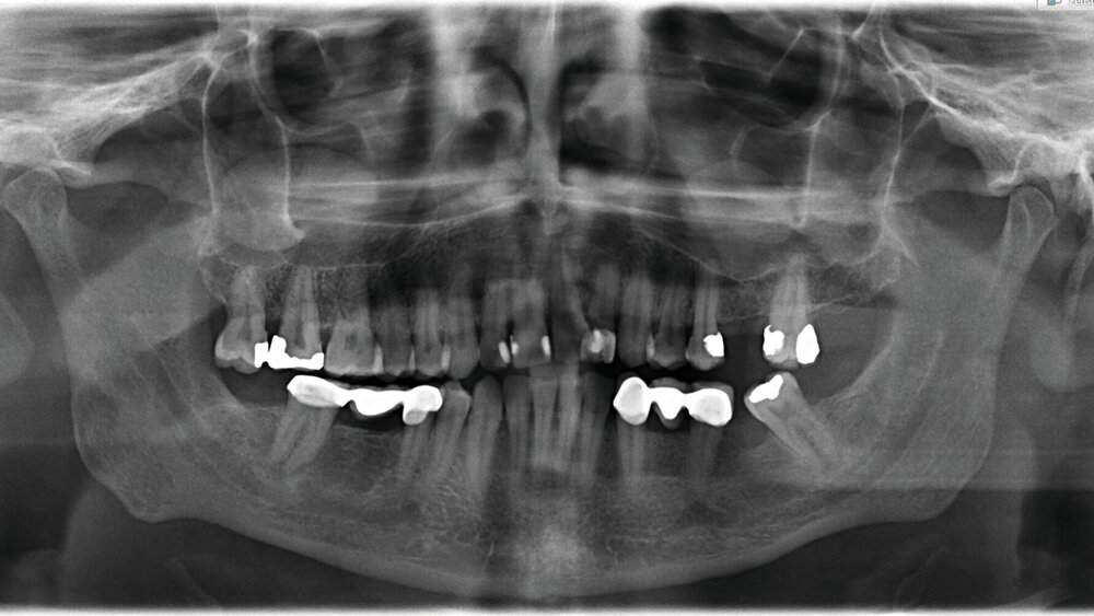 Abb. 1: Das alte OPG zeigt zystische Läsionen Regio 17 und 26.