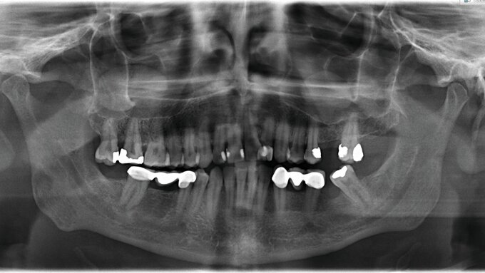 Abb. 1: Das alte OPG zeigt zystische Läsionen Regio 17 und 26.