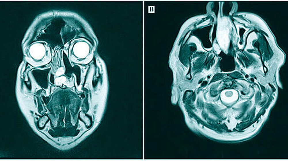 Abbildung 1: MRT-Bildgebung, T2-gewichtet, A = coronale Schichtung, B = axiale Schichtung: Tumorinfiltration von Nasenseptum, linkem Sinus maxillaris und Oberkiefer Abbildung 1: MRT-Bildgebung, T2-gewichtet, A = coronale Schichtung, B = axiale Schichtung: Tumorinfiltration von Nasenseptum, linkem Sinus maxillaris und Oberkiefer