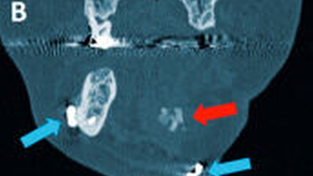 Abbildung 4: Die Reossifikation (rote Pfeile) nach einem halben Jahr postoperativ dargestellt im CT in der axialen Schichtung (a), in der transversalen Schichtung im anterioren Bereich (b) und im posterioren Bereich (c), mit vorhandener Rekonstruktionsplatte (blaue Pfeile) |