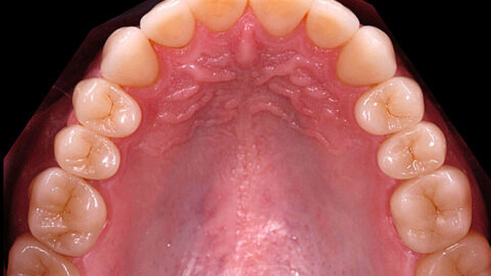 Abbildung 5: Definitive Versorgung: Nach eingehender funktioneller und ästhetischer Evaluierungsphase wurden die semipermanenten Versorgungen in definitive Restaurationen aus Lithiumdisilikat (IPS e.max Press) überführt. Schichttechnik im Frontzahnbereich und monolithische Onlays im Seitenzahnbereich. |