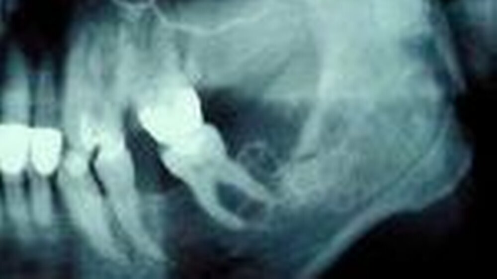 Abbildung 1: Ausschnitt des Orthopantomogramms der Patientin mit Darstellung des Myxoms im Bereich des linken Unterkiefers. Erkennbar ist die Seifenblasenstruktur des Knochens von regio 36 bis zur Basis des Muskelfortsatzes. Außerdem ist der Zahn 38 bis