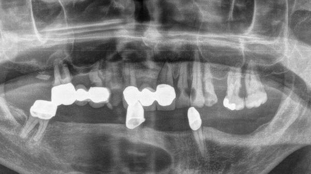 Abbildung 1: Orthopantomogramm mit einer ausgedehnten zystischen Raumforderung regio 41 bis 45 (Stern)