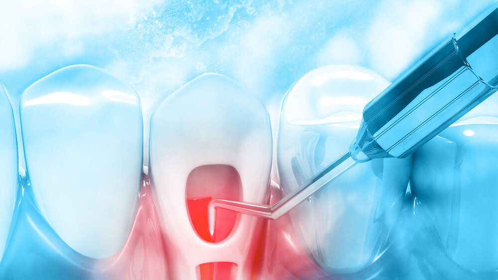 Das Ziel dieser Meta-Analyse war, den postoperativen Schmerz (PP) nach einer nicht-chirurgischen endodontischen Revision in einer Sitzung im Vergleich zu mehreren Besuchen zu bewerten.