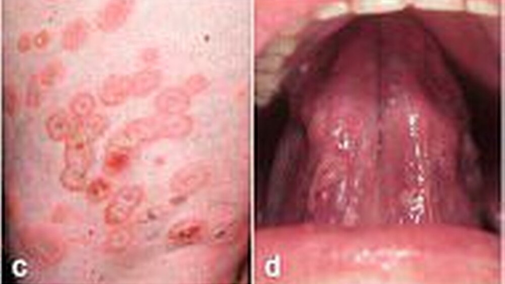 Abbildung 6: Bullöses Pemphigoid: a: pralle Blasen auf erythematösem Grund oder normaler Haut, b: wenige Erosionen und Eytheme am Gaumen; Lineare IgA-Dermatose: c: annulär angeordnete pralle Blasen, d: Erosionen am Zungenboden; Epidermolysis bullosa acquisita: inflammatorische Variante mit e: multiplen Erosionen an Haut und f: Mundschleimhaut. Bei bullösem Pemphigoid, linearer IgA Dermatose und Epidermolysis bullosa acquisita finden sich die Läsionen vor allen an der Haut. |