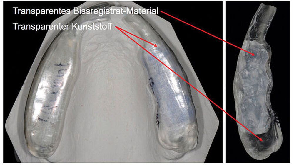 Abbildung 2: Auf dem Wax-up- Modell hergestellte Übertragungsschienen zur Anfertigung der direkten okklusalen Kompositaufbauten im Seitenzahnbereich |