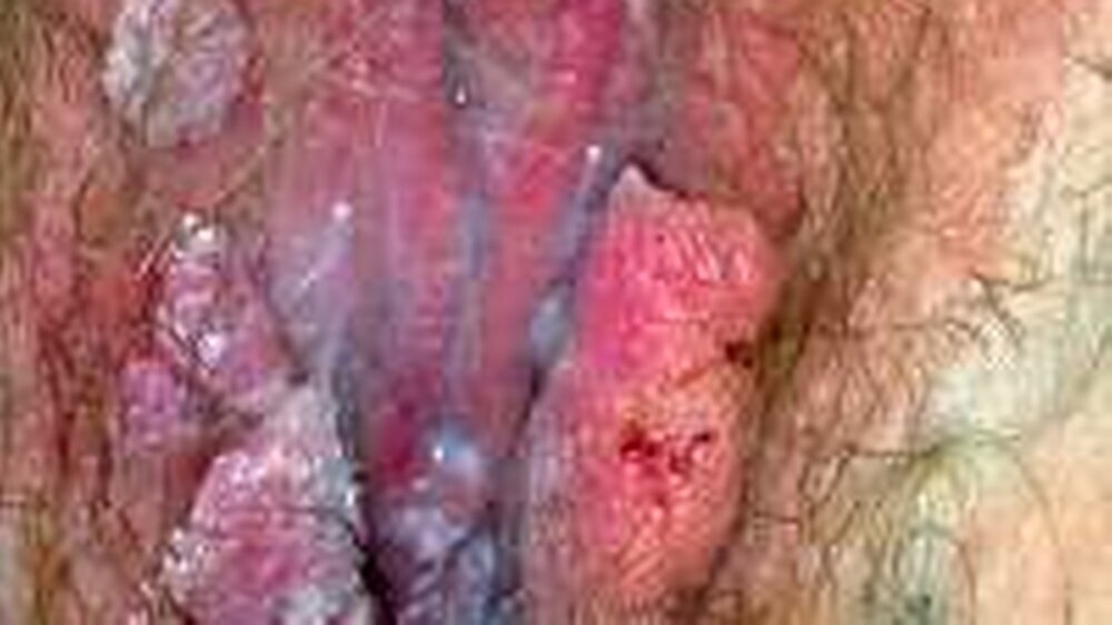 Condyloma acuminatum – Infektion einer 17-jährigenPatientin am Genital
