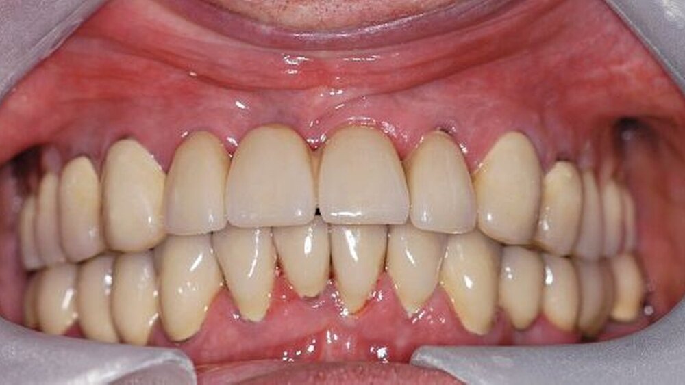 Abbildungen 16a, 16b, 16c, 16d, 16e: Abschlussbefund (definitiv befestigte Kronen und Brücken sowie eingegliederte partielle obere Prothese). |