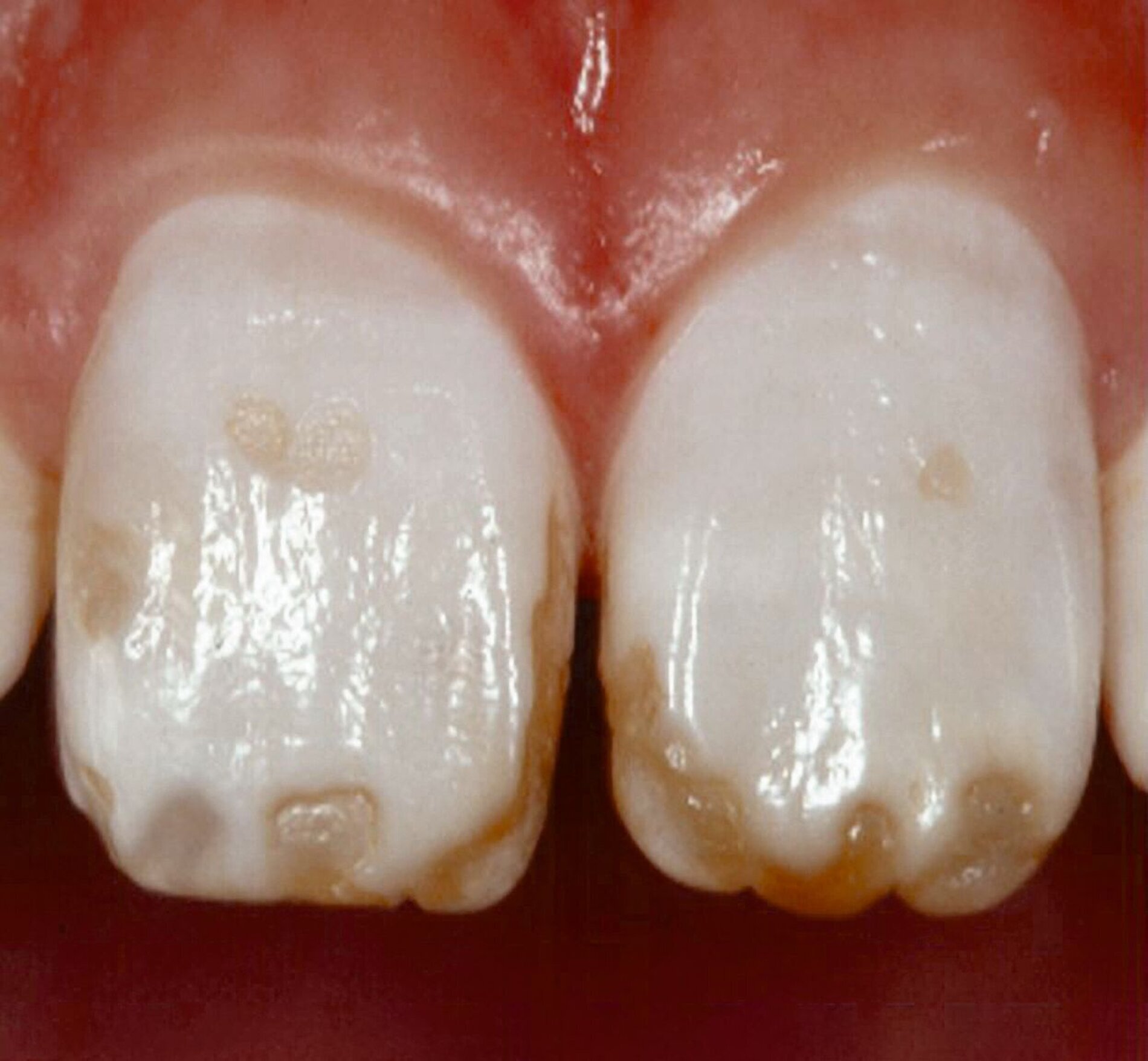 Führt eine Kariesprävention mit Fluoridlack zu mehr Fluorose?