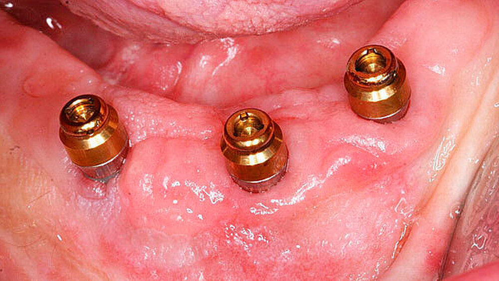 Abbildung 1: Candida albicans Infektion unter implantat-getragener Prothesenversorgung. |