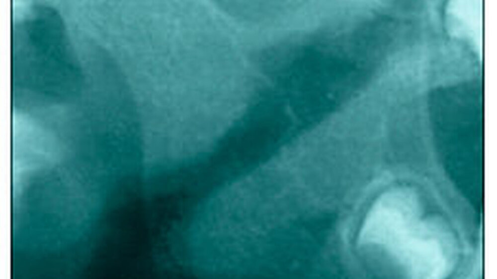 Abbildung 3d: Vollständige Destruktion des Kondylus |