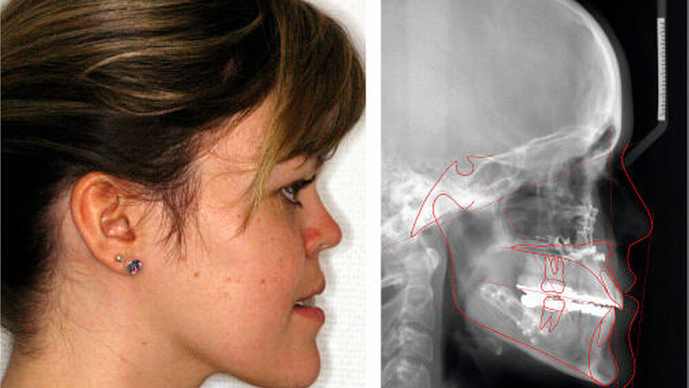 Abbildung 6: FRS und laterales Profil post OP |