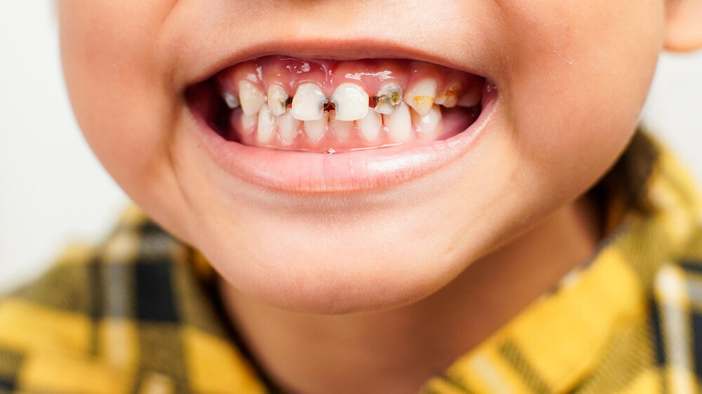 Close-up of a child showing severe tooth decay and plaque on upper teeth