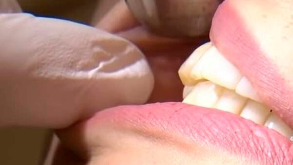 Aufgrund zunehmender Schmerzen und Schwierigkeiten beim Essen brach Patientin Celine ihre Behandlung bei Aligneranbieter DrSmile ab, berichtet der NDR. Anschließend begab sie sich in Behandlung bei der niedergelassenen Kieferorthopädin Dr. Luzie Braun-D