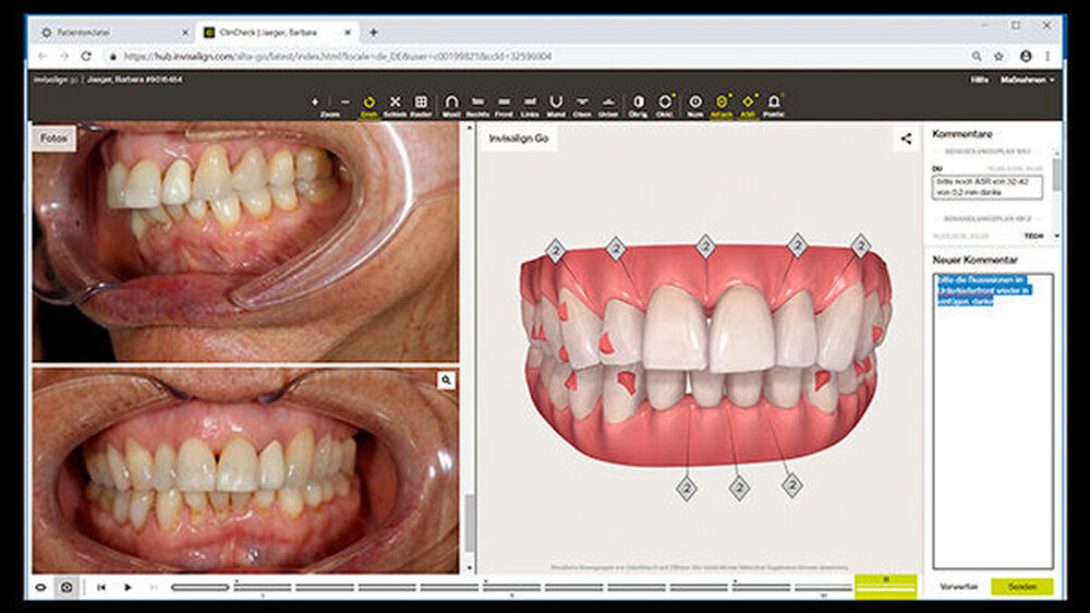 Mit dem digitalen Planungstool ClinCheck kann die Zahnumstellung mit Invisalign Go detailliert geplant werden.