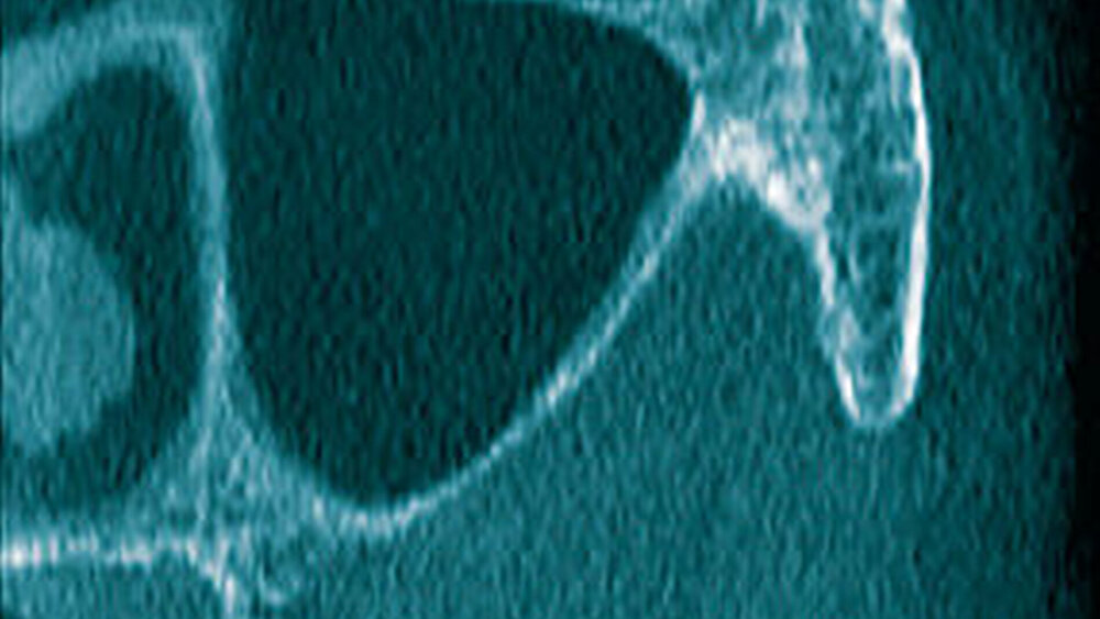 ... coronarer (3b) ... |