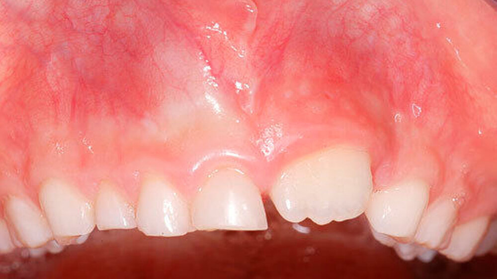 Abbildungen 1 bis 3: Überzähliger Milchzahn 52+ bei einem knapp achtjährigen Knaben mit verzögertem Durchbruch der bleibenden Oberkieferfronzähne. In der digitalen Volumentomografie erkennt man zudem einen überzähligen lateralen Schneidezahn 12+ (1: frontale Ansicht;) |