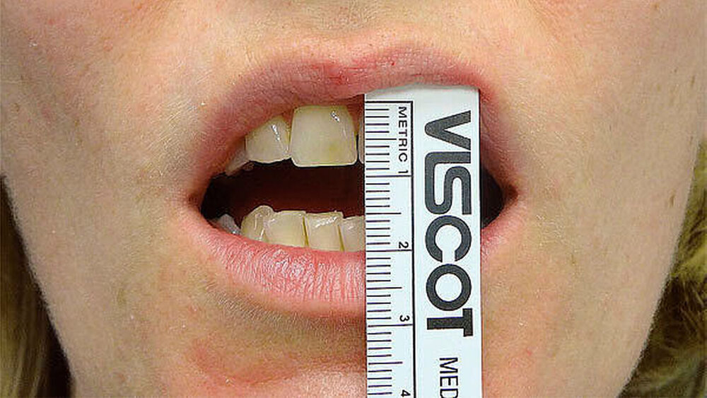 Eingeschränkte Mundöffnung bei der Erstvorstellung. |