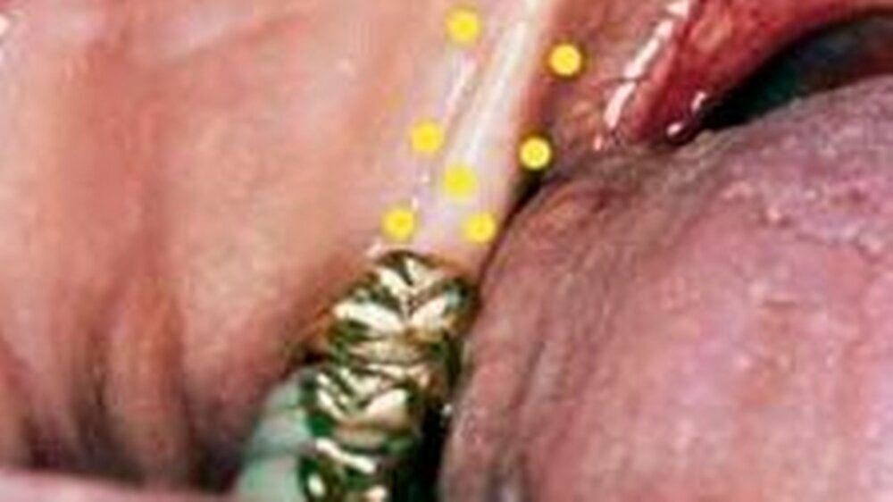Retromolarpunkte im Unterkiefer: Diese Punkte sind individuell aufzusuchen und zu therapieren.