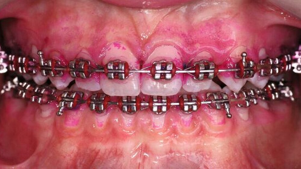 Plaqueakkumulation (detektiert mit Färbemethode) an vestibulärer Apparatur sowie rechts bei lingualer Apparatur. |