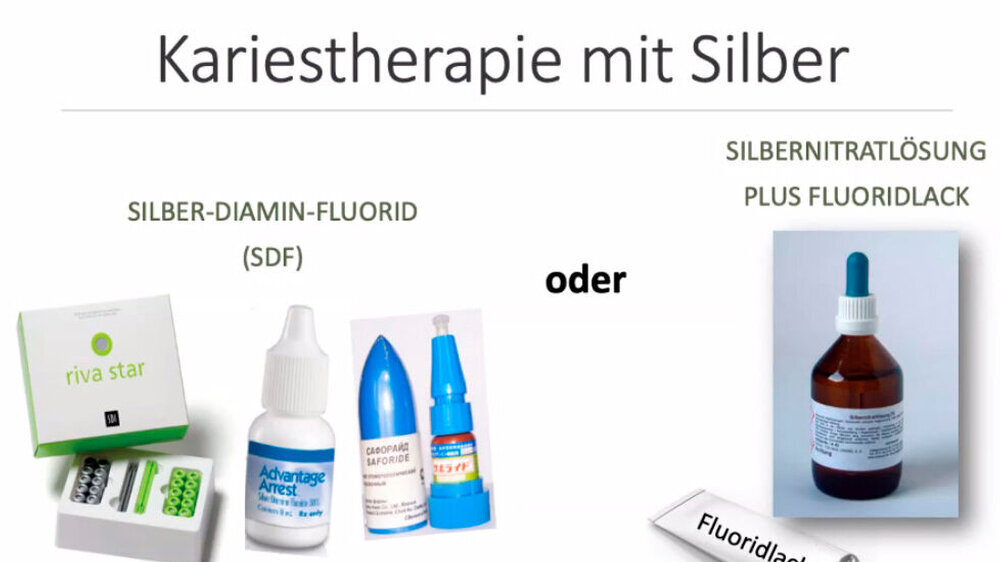 Dr. Ulrike Uhlmann, Leipzig, berichtete über die Anwendung silberhaltiger Verbindungen zur Kariesbehandlung. Silbernitratlösungen wurden schon vor über 100 Jahren in der Zahnmedizin angewandt. Silberdiaminfluorid (SDF) findet seit Ende der 60er Jahre V