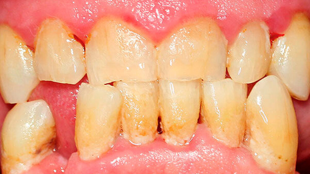 Abbildung 1: Dentale Biofilme sind die primäre Ursache für entzündliche Parodontalerkrankungen.\r\n\r\n