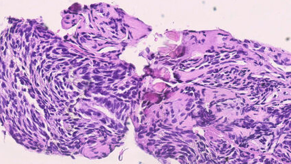 Abbildung 4: Kalzifizierender epithelialer odontogener Tumor mit fibrösem Stroma mit polygonalen, netzartigen, bandförmigen Epithelien und hier zentral gelegenen Verkalkungen: Vermehrte Mitosen konnten mit einer additiven Ki-67-Färbung nicht nachgewiesen werden, so dass ein maligner Befund ausgeschlossen werden konnte. |