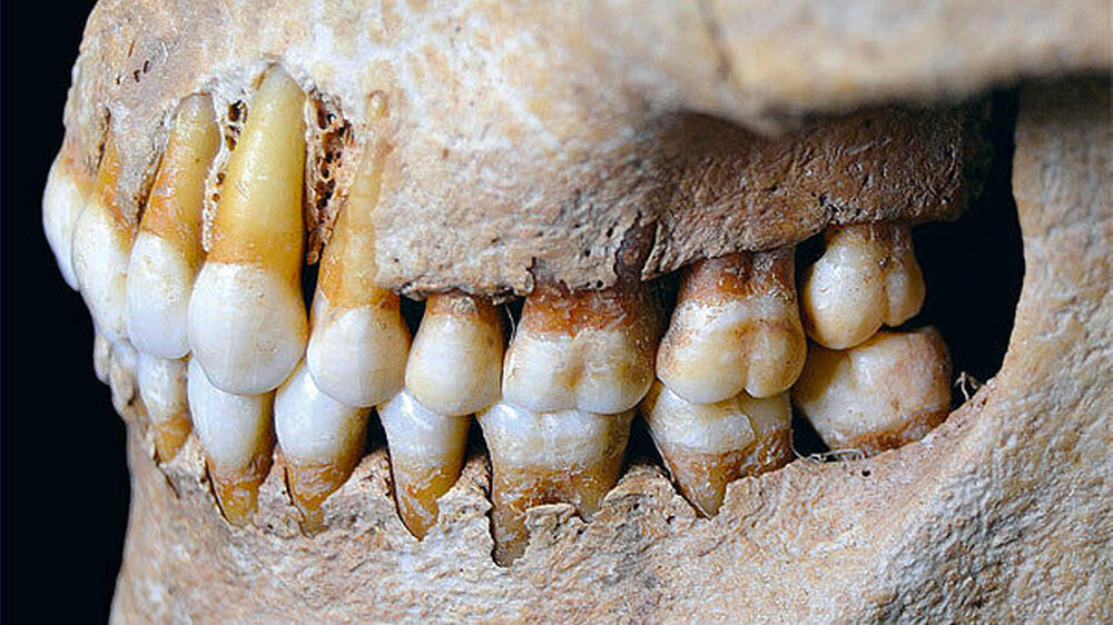 Für eine komplett andere Auseinandersetzung mit dem Thema Okklusion – aus der Perspektive der Evolutionsforschung – plädieren Prof. Dr. Kurt Alt, Basel/Krems, Dr. Ottmar Kullmer, Frankfurt, und Prof. Jens Türp, Basel: Die Abnutzungsvorgänge/ Hartg Für eine komplett andere Auseinandersetzung mit dem Thema Okklusion – aus der Perspektive der Evolutionsforschung – plädieren Prof. Dr. Kurt Alt, Basel/Krems, Dr. Ottmar Kullmer, Frankfurt, und Prof. Jens Türp, Basel: Die Abnutzungsvorgänge/ Hartgewebeveränderungen dürfen nicht länger als pathologisch bezeichnet werden. Vielmehr ist die „perfekte“, evoluiv bewährte, abasionsbedingte Okklusion der heutigen statischen, „zementierten“ Okklusion vorzuziehen.