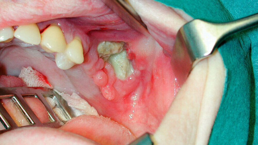 Antiresorptiva-assoziierte Kiefernekrose (AR-ONJ) nach Extraktion des Zahnes 27 ohne Kautelen (perioperative Antibiotikagabe, modellierende Osteotomie scharfer Knochenkanten, plastische Deckung).