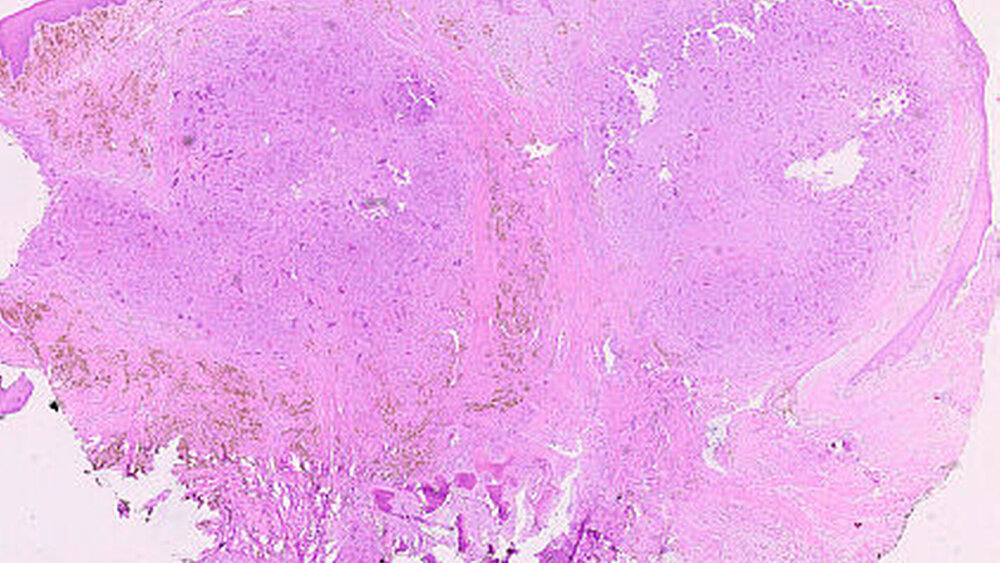 Abbildung 4: Übersichtsaufnahme eines zellreichen Proliferats, das von einem normal geschichteten Plattenepithel überzogen ist (Vergrößerung x1,5). |