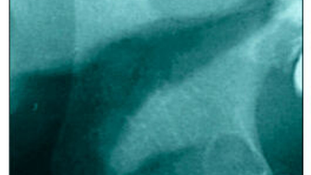 Abbildung 3c: Abflachung des Kondylus |