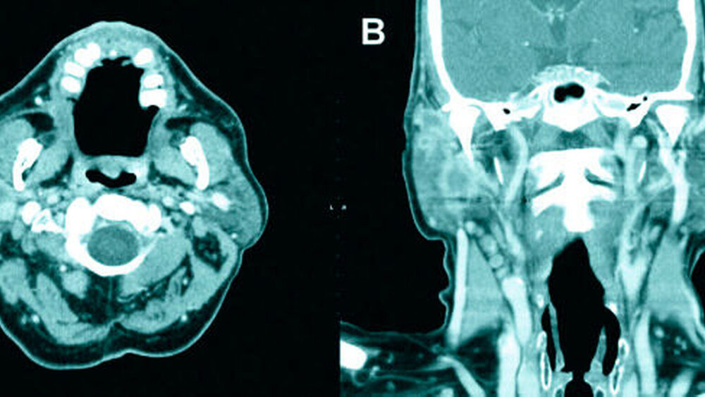 Abbildung 4: Präoperative Computertomographie im Weichteilfenster (A: axial, B: coronar) mit unscharf begrenzter, inhomoger Kontrastmittel-aufnehmender, lobulär strukturierter Raumforderung |