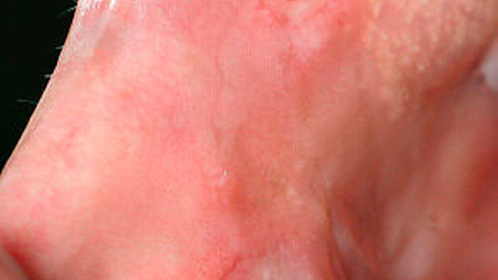 Abbildung 2: Plaques muqueuses bei Lues II am rechten Planum buccale (Patient männlich, HIV-positiv, 42 Jahre) |