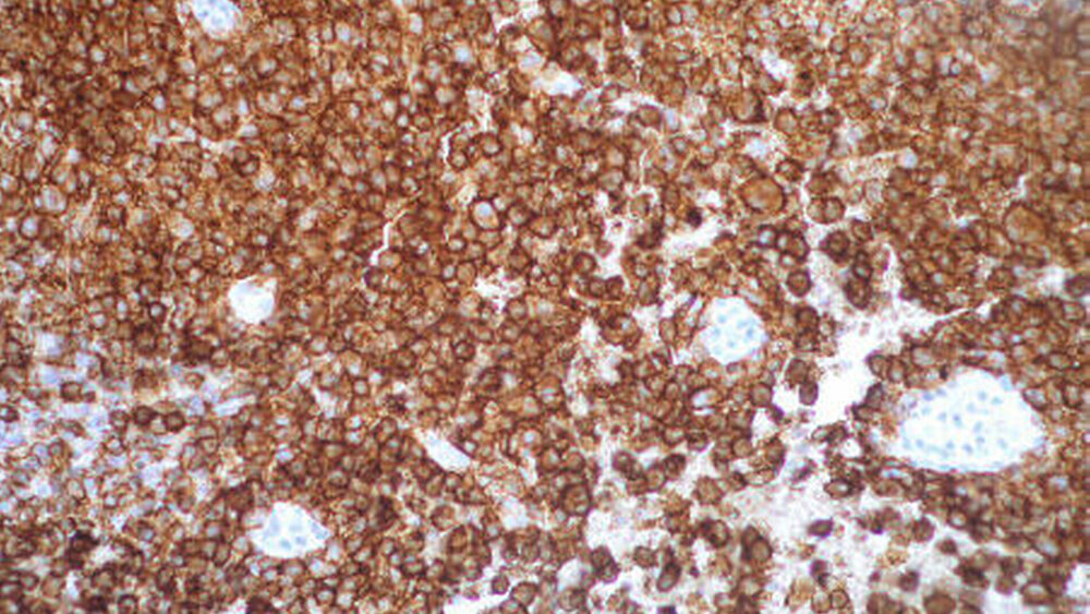 Abbildung 4: HE 100 x, Fibrose mit Infiltration einer Langerhanszell-Histiozytose, eosinophilen Granulozyten und mehrkernigen Riesenzellen |