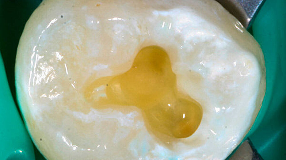 Abbildung 7: Feuchte Dentin-Oberfläche nach dem Rewetting. Nach dem Rewetting soll das Dentin leicht glänzen, es sollten aber keine Pfützen sichtbar sein.