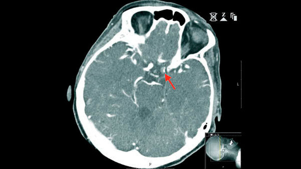 Abbildung 1: Nachweis eines Thrombus in der Arteria carotis interna | Abbildung 1: Nachweis eines Thrombus in der Arteria carotis interna |