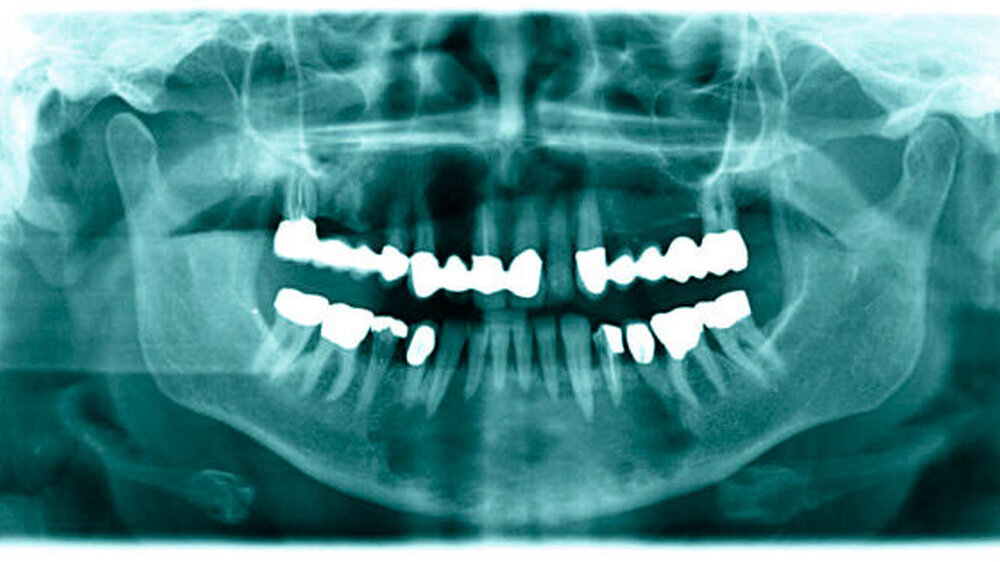 Abbildung 1: Panoramaschichtaufnahme zum Zeitpunkt der Erstvorstellung mit einem radiotransluzenten, unscharf berandeten, von regio 35/36 bis 45/46 reichenden Prozess | Abbildung 1: Panoramaschichtaufnahme zum Zeitpunkt der Erstvorstellung mit einem radiotransluzenten, unscharf berandeten, von regio 35/36 bis 45/46 reichenden Prozess |
