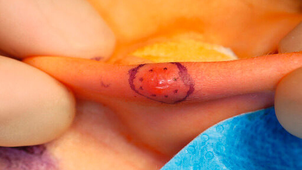 Abbildung 3: Einzeichnen der prospektiven Exzision bei Primäroperation und  Arbeitsdiagnose eines atypischen Spitz-Naevus |