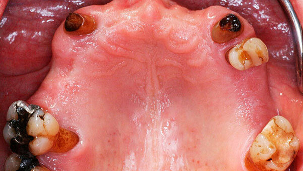 Abbildung 1: All-on-4 Konzept a) Ausgangssituation mit nicht erhaltungsfähigen Restzähnen aufgrund ausgeprägter parodontaler Einbrüche. |