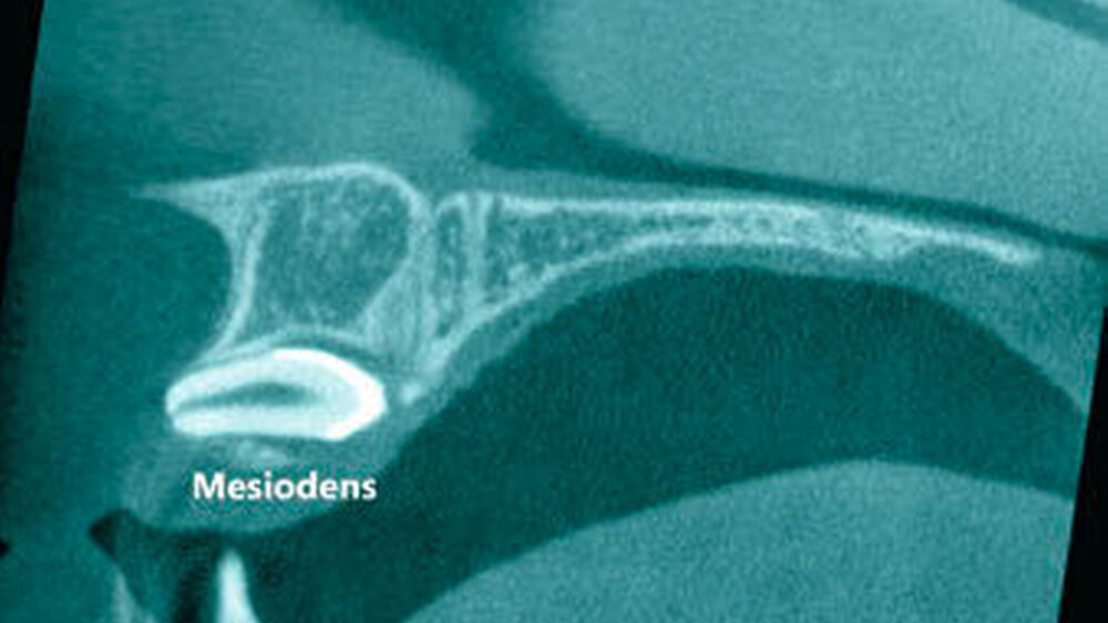 3d: Sagittalschnitt mit Darstellung des Mesiodens. |